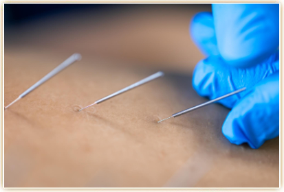 acupuncture