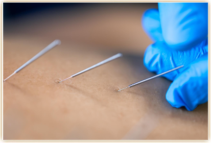 acupunture services